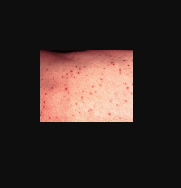 What is GD | GROVERs disease TREATMENT, skin rash,